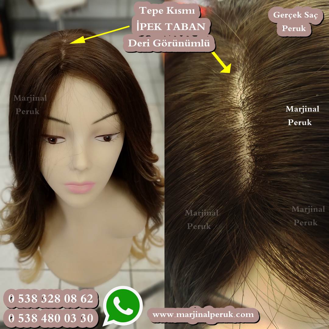 alopesi peruk