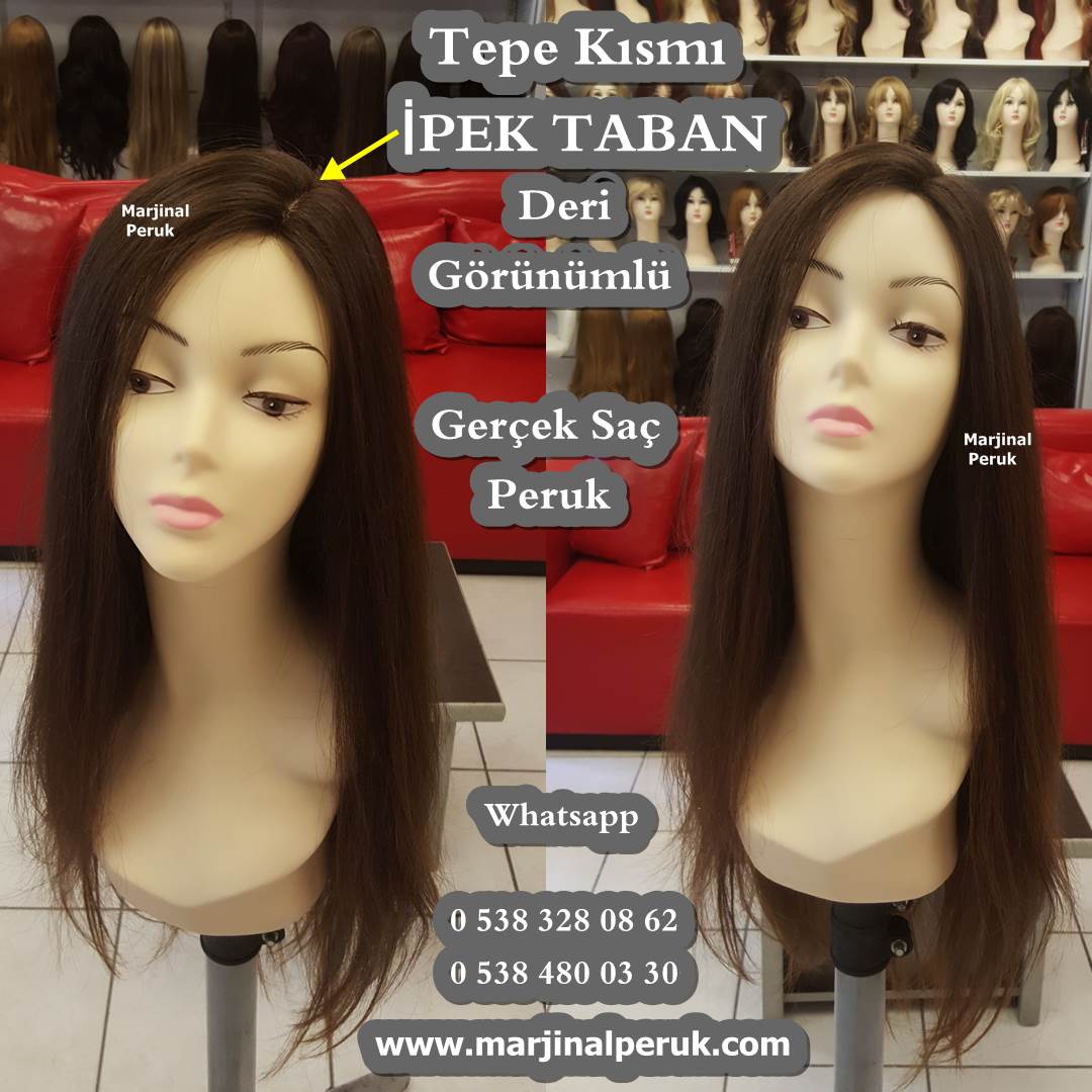 alopesi peruk