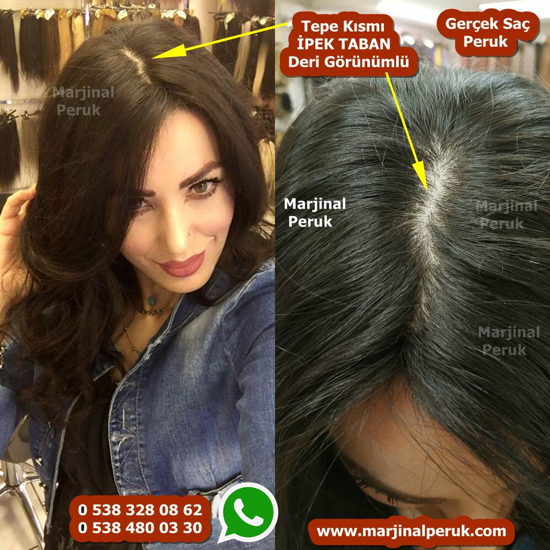 alopesi peruk