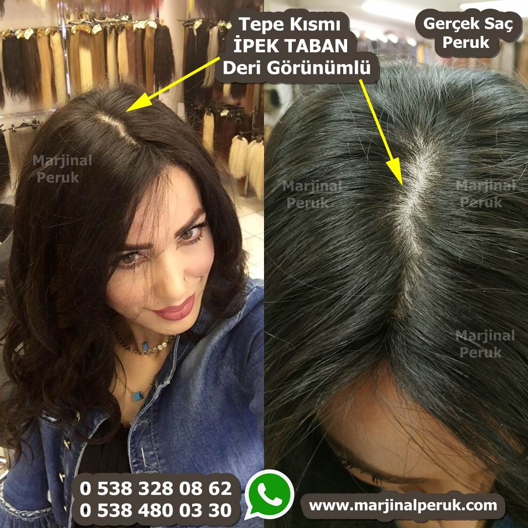 alopesi peruk, kemoterapi peruk