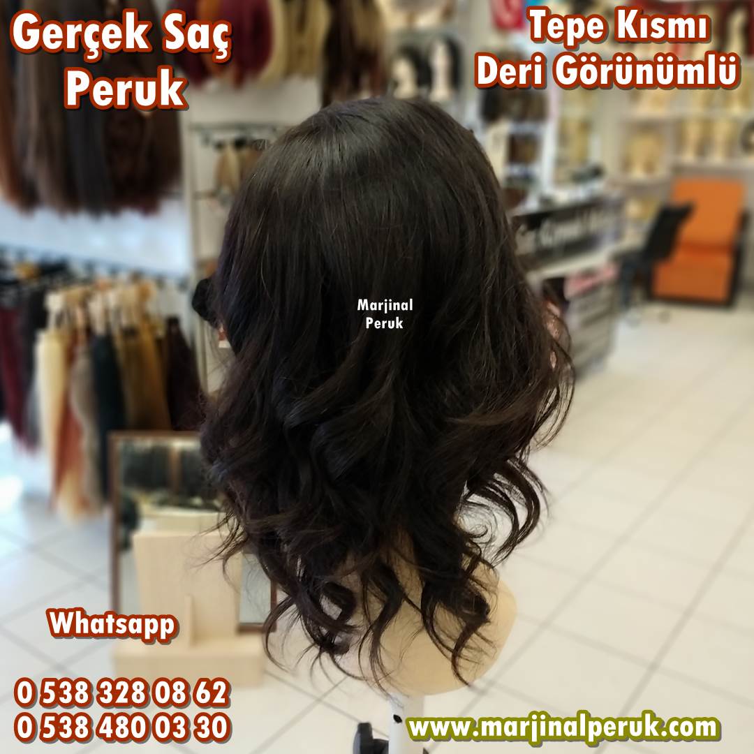 alopesi peruk