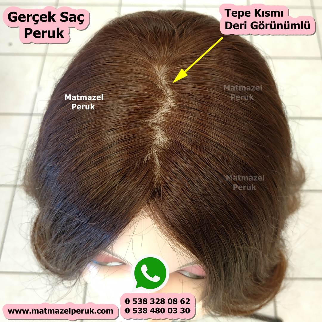 alopesi peruk